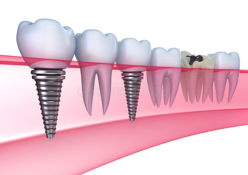 Implantes dentais na goma ilustração royalty free Implantes dentais na goma ilustração royalty free