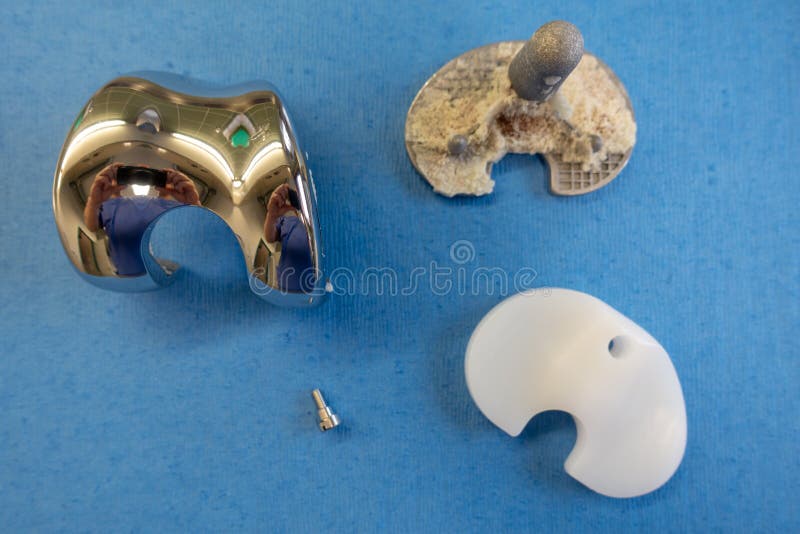 Implants enlev?s d'une proth?se de genou photo libre de droits Implants enlev?s d'une proth?se de genou photo libre de droits