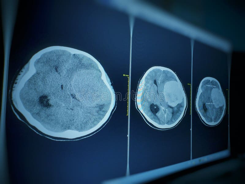 Impression de cerveau de CT des sept cm la masse supplémentaire-axiale avec l'amélioration de stong et effet de masse à l'hémisph image stock Impression de cerveau de CT des sept cm la masse supplémentaire-axiale avec l'amélioration de stong et effet de masse à l'hémisph image stock