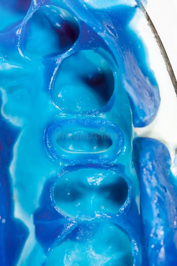 Impression of a Tooth after Dental Crown Preparation Stock Image