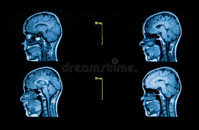 Imágenes de una tomografía automatizada del cerebro fotos de archivo libres de regalías Imágenes de una tomografía automatizada del cerebro fotos de archivo libres de regalías