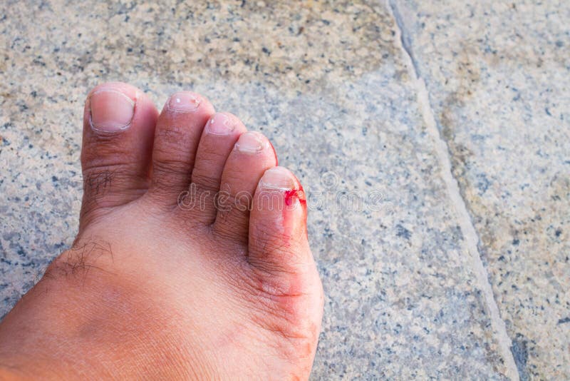 Incised Bloody Wound On The Foot Of A Man Stock Photo Image 64058168