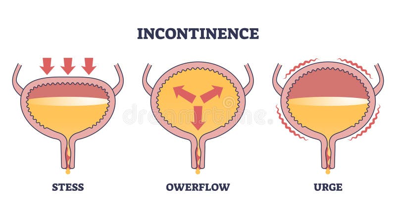 Incontinence problem with stress, owerflow and urge types outline diagram