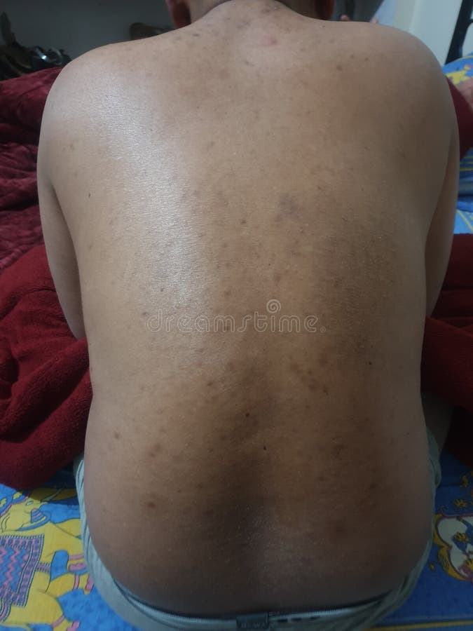 Indian Mosquito Bite a Common Problem Stock Image Image of india