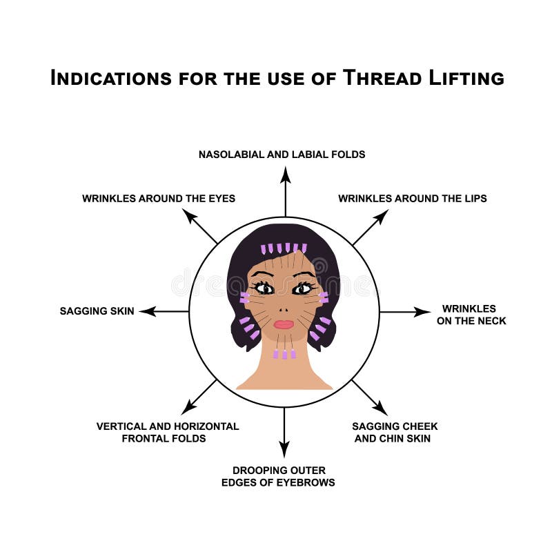 Indications for the use of thread lifting. Mesotherapy Wrinkles. Infographics. Vector illustration on isolated stock illustration