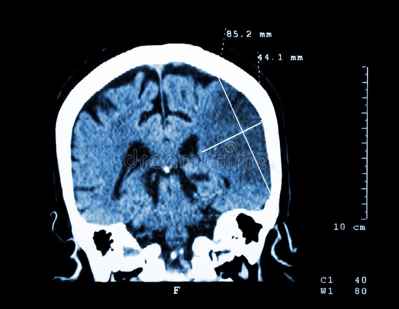 Infarctus cérébral à l'hémisphère gauche (course ischémique) (CT-balayage de cerveau) : Fond de médecine et de la Science image libre de droits Infarctus cérébral à l'hémisphère gauche (course ischémique) (CT-balayage de cerveau) : Fond de médecine et de la Science image libre de droits