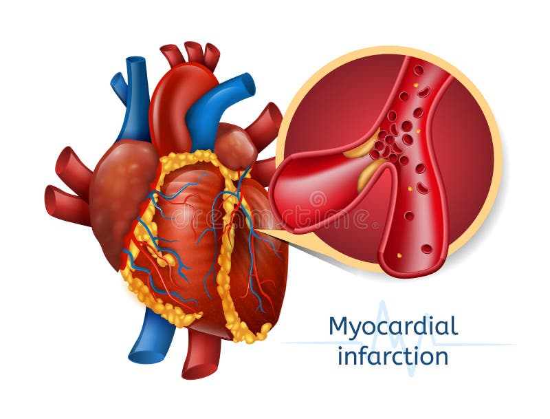 Infarto del miocardio corazón de 3d Realostic stock de ilustración Infarto del miocardio corazón de 3d Realostic stock de ilustración