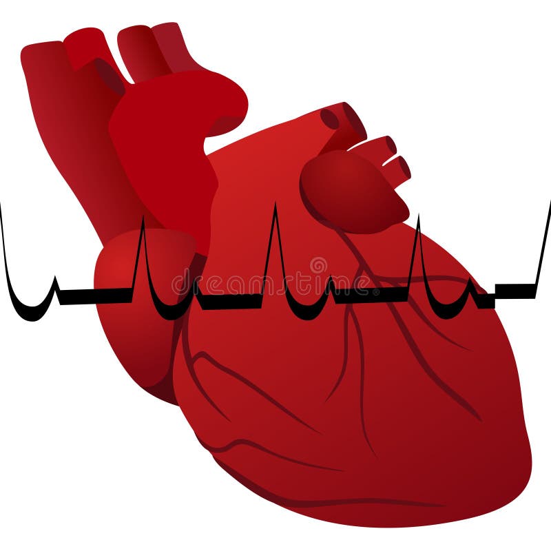 Infarto miocardico illustrazione vettoriale Infarto miocardico illustrazione vettoriale