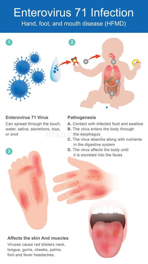 Infección del enterovirus 71 Mano, pie, y enfermedad de la boca
