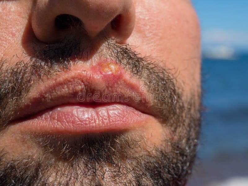 Infección en el primer de la cara del hombre Quemadura de Sun o infección bacteriana Problema médico de la piel Virus o inflamaci