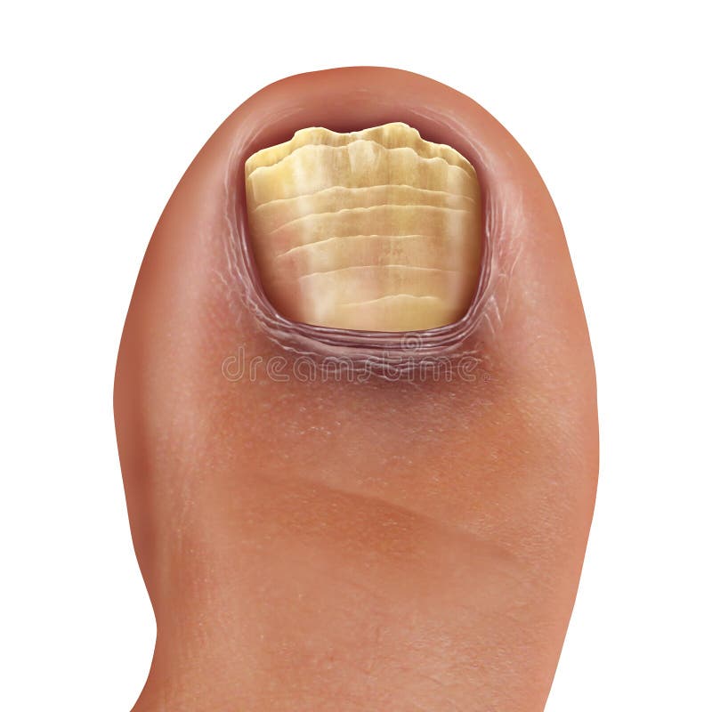 Infected Fungal Toe Nail