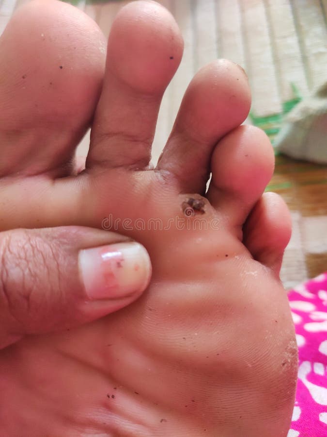 infected corn on toe