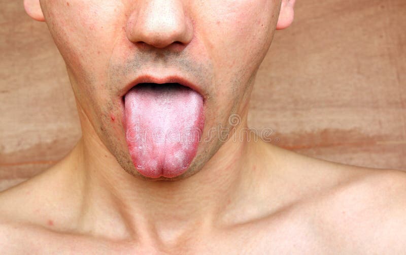 Infection tongue stock photography