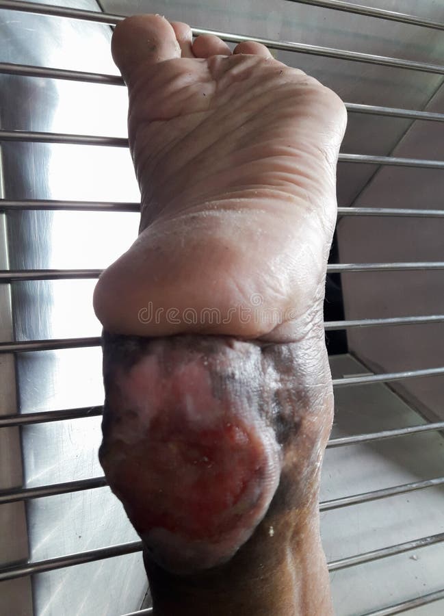 Infektionsår arkivbilder Infektionsår arkivbilder