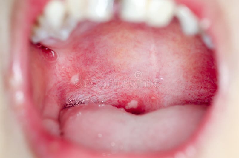 Bolla Di Sangue In Bocca Infezione Della Bocca Dell'interno Dell'ulcera Immagine Stock
