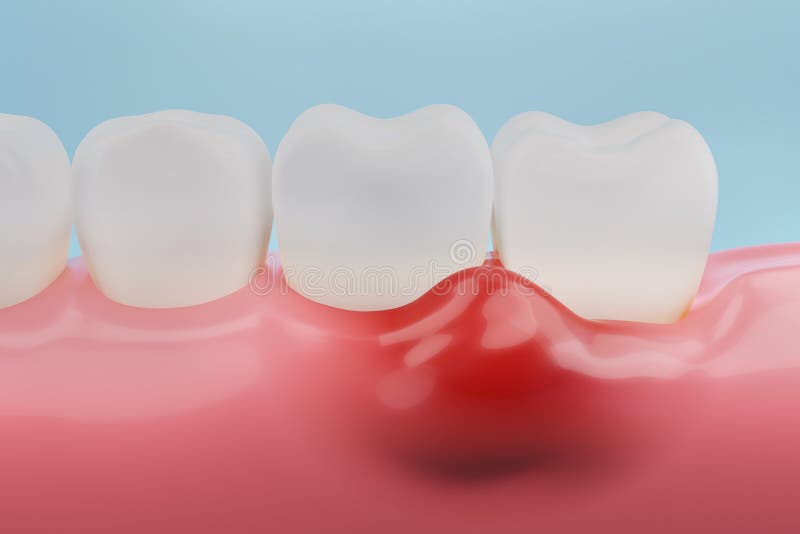Gums inflammation, gingival recession. Dental treatment concept. 3D rendering. Gums inflammation, gingival recession. Dental treatment concept. 3D rendering.