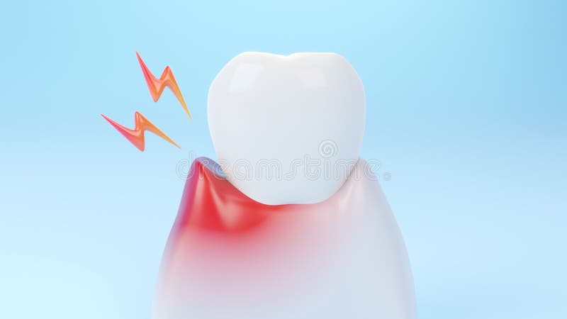 Gums gum inflammation, gingival recession. Dental treatment concept. 3D rendering. Gums gum inflammation, gingival recession. Dental treatment concept. 3D rendering.