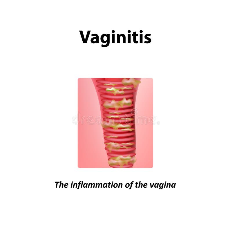 Tratamento de supositórios de vaginite. inflamação da vagina. Infográficos.  ilustração vetorial em fundo isolado imagem vetorial de mikrostoker©  136049596