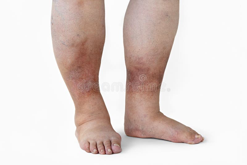 Inflamed Legs Of A Woman With Diabetes Close Up Stock Image Image Of
