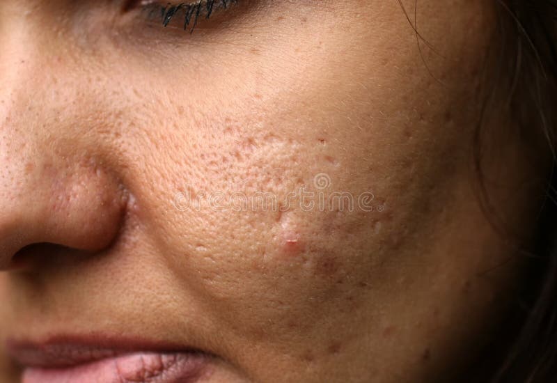 Inflamed Skin Of The Face In Pimples And Acne Keloid Scars From Acne