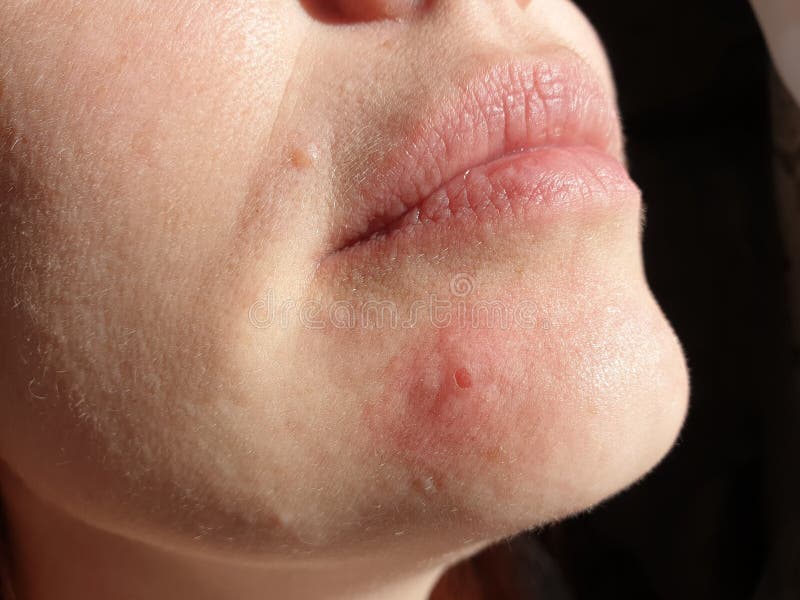 Inflammation on the Female Skin, Acne and Irritation, Skin Problems