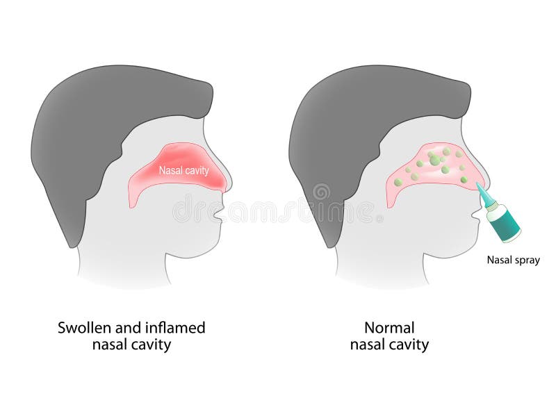 Inflammation of the nasal cavity and nasal cavity healthy