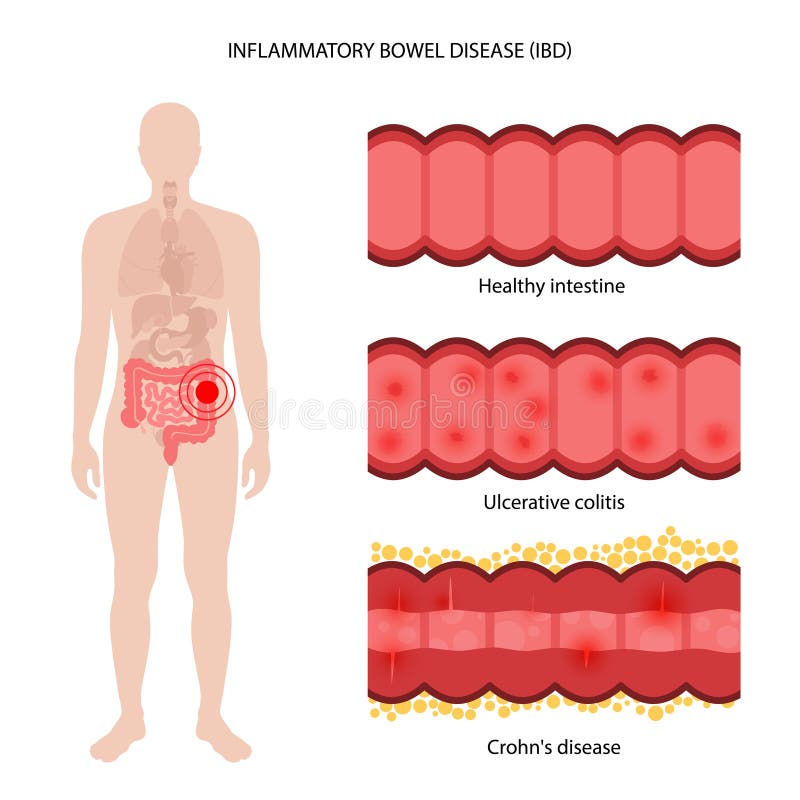 Inflammatory bowel disease stock vector. Illustration of inflammation -  225292786