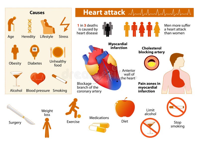 Infographic hartaanval