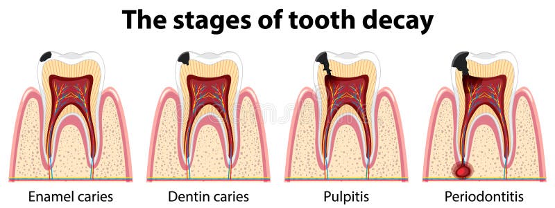 Infographic of Human in the Stages of Tooth Decay Stock Illustration ...