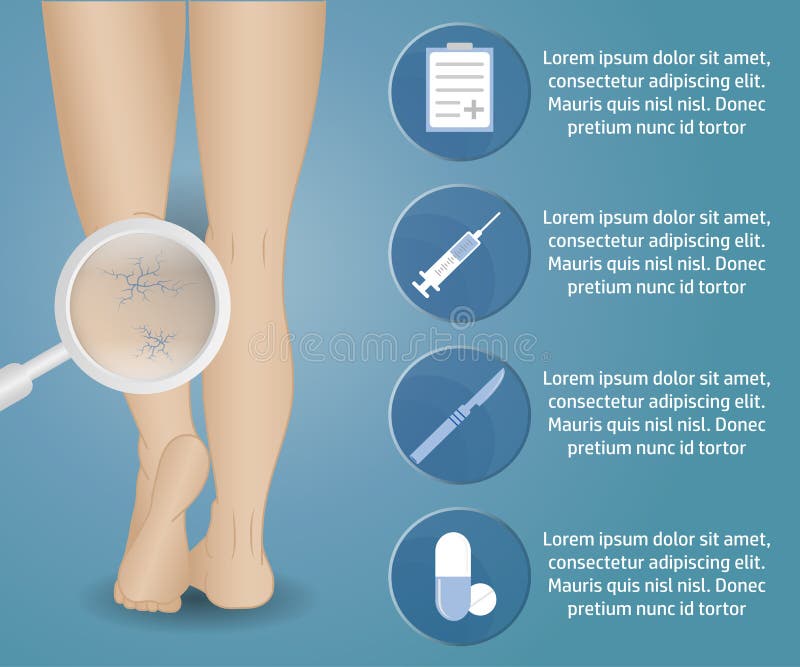 Infographics del vector de Phlebology libre illustration Infographics del vector de Phlebology libre illustration