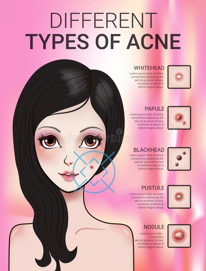 Infographics of different type of skin acne royalty free illustration Infographics of different type of skin acne royalty free illustration