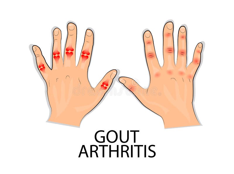 Infographics for disease gout, podagra vector illustration