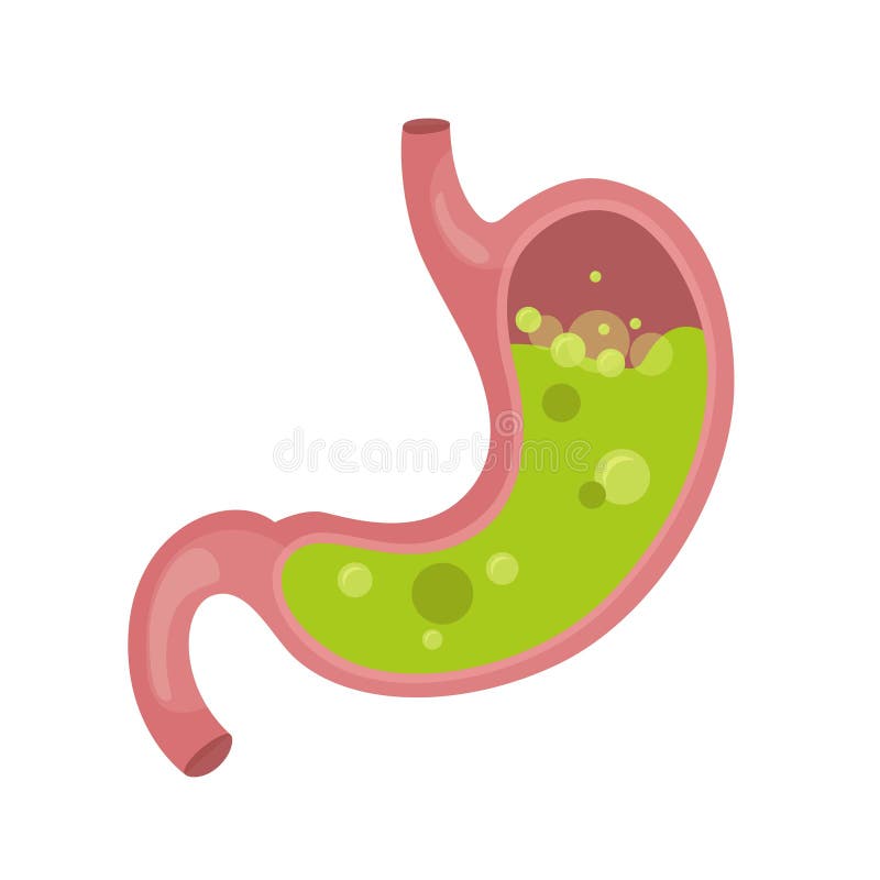 Infographics of gastritis vector illustration Infographics of gastritis vector illustration