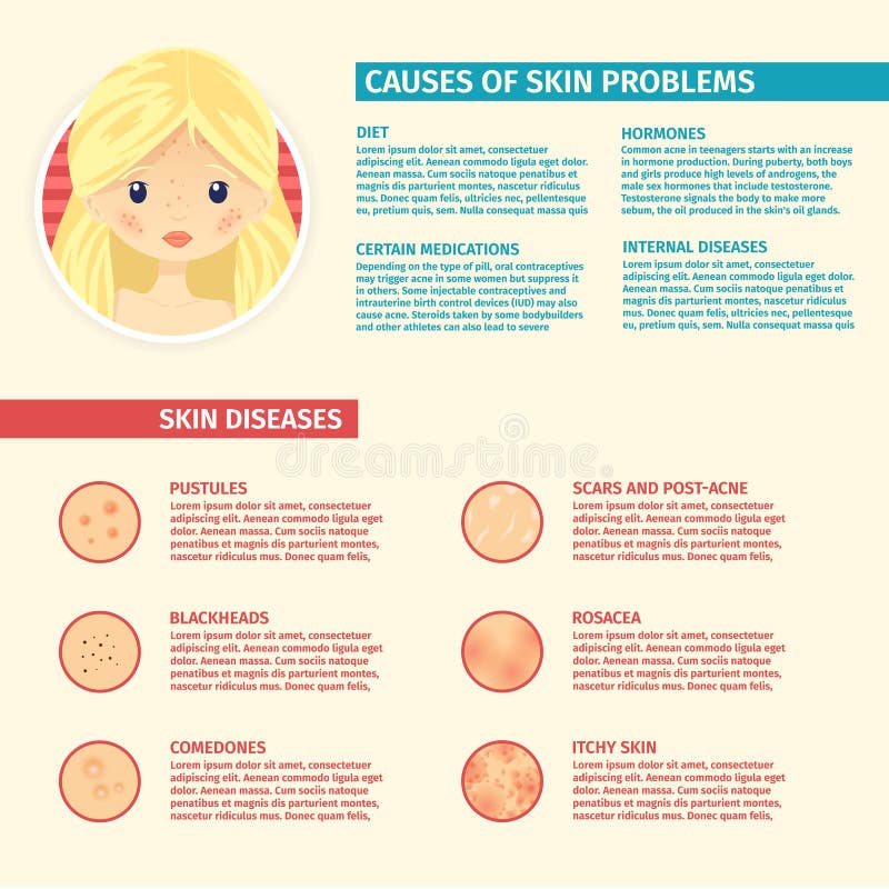 Infographics skóra problemy przyczyny problemowa skóra, typ problemy Blondynki dziewczyna z trądzikiem, pores, okalecza royalty ilustracja Infographics skóra problemy przyczyny problemowa skóra, typ problemy Blondynki dziewczyna z trądzikiem, pores, okalecza royalty ilustracja