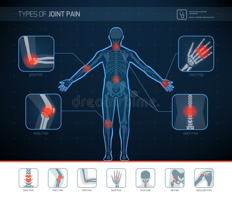 Types of joint pain medical infographic with icons. Types of joint pain medical infographic with icons