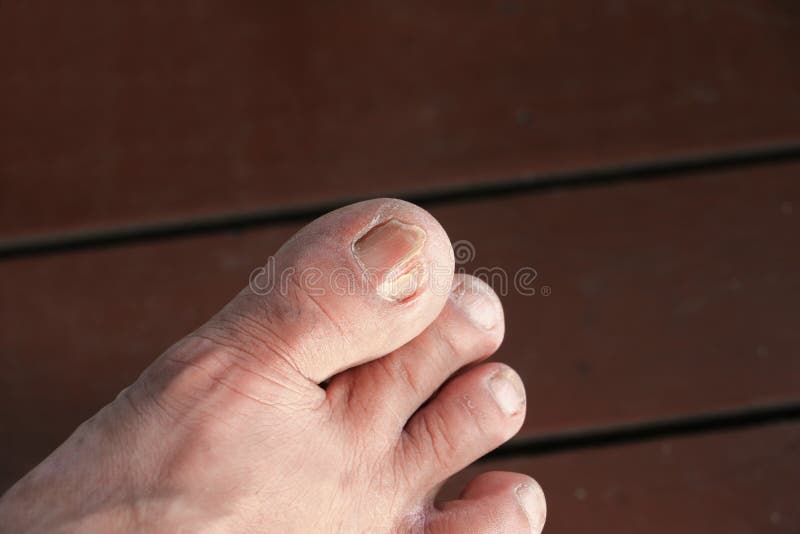 Ingrown nail Big toe selective focus, broken toenail on wood floor royalty free stock image Ingrown nail Big toe selective focus, broken toenail on wood floor royalty free stock image
