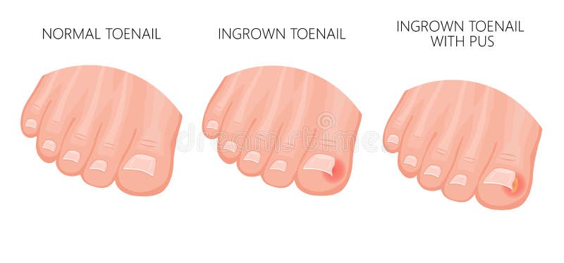 Vektorové ilustrace zdravé nohy, nohy s zarostlých nehtů, ošetření zarostlých nehet a prst se infikované tkáně a hnisu kapsy.