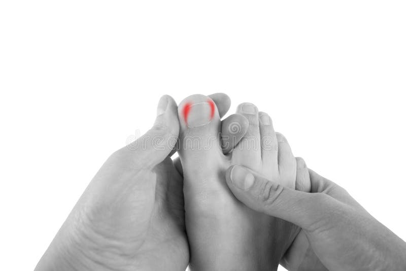 Ingrown toenails on a woman`s foot, isolated on white background, pain in the big toe