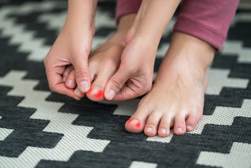 Ingrown toenails on a woman`s foot, pain in the big toe