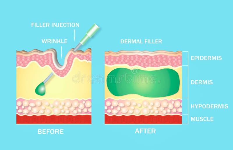 injectable cosmetic filler or Dermal fillers