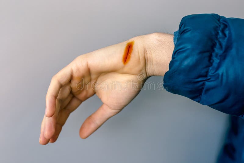 Injured Hand with Open Cut, Stock Image Image of hand