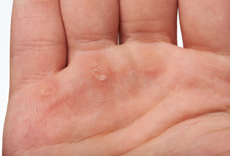 Injured Palm Hand Stock Photo Image Of Blisters Hand 126274216