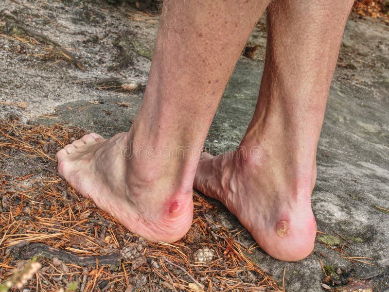 Naked male legs with horrible blister on peak. Injured rock climber heel stock photo Naked male legs with horrible blister on peak. Injured rock climber heel stock photo