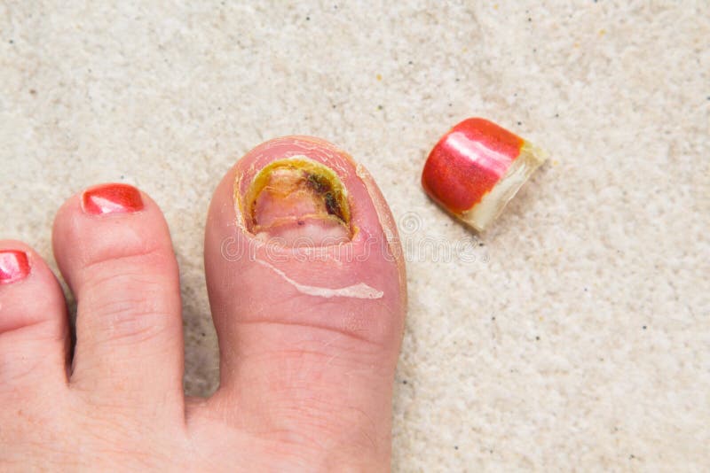 Ingrown Toenail - Symptoms, Treatment, Prevention