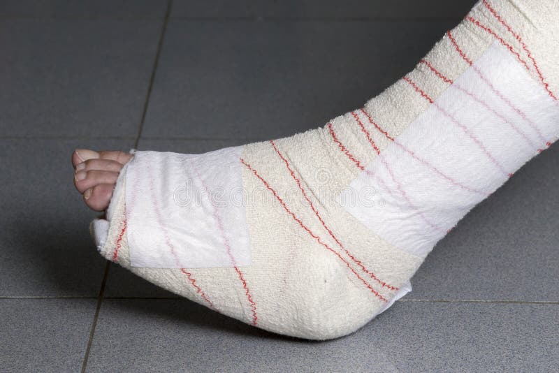 Injuries from tendon stock photo. Image of cast, foot 93165638