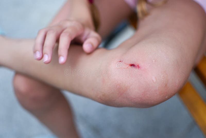 Injury Wound Of A Child`s Leg A Cut Children`s Knee First Aid For A