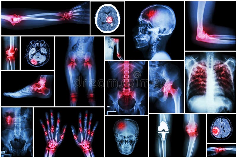 Inkasowego promieniowania rentgenowskiego wieloskładnikowa choroba (artretyzm, uderzenie, rak mózgu, podagra, rheumatoid, cynader obraz royalty free Inkasowego promieniowania rentgenowskiego wieloskładnikowa choroba (artretyzm, uderzenie, rak mózgu, podagra, rheumatoid, cynader obraz royalty free