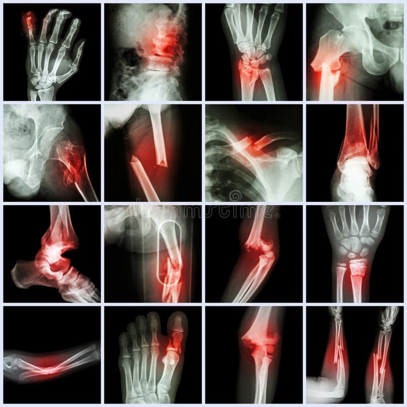 Inkasowy Radiologiczny wieloskładnikowy kość przełam zdjęcie royalty free