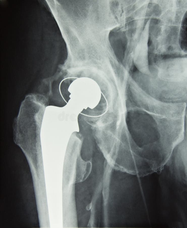 Innesto della protesi dell'anca, rimontaggio dell'anca
