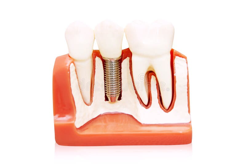 Innesto dentale immagini stock libere da diritti Innesto dentale immagini stock libere da diritti